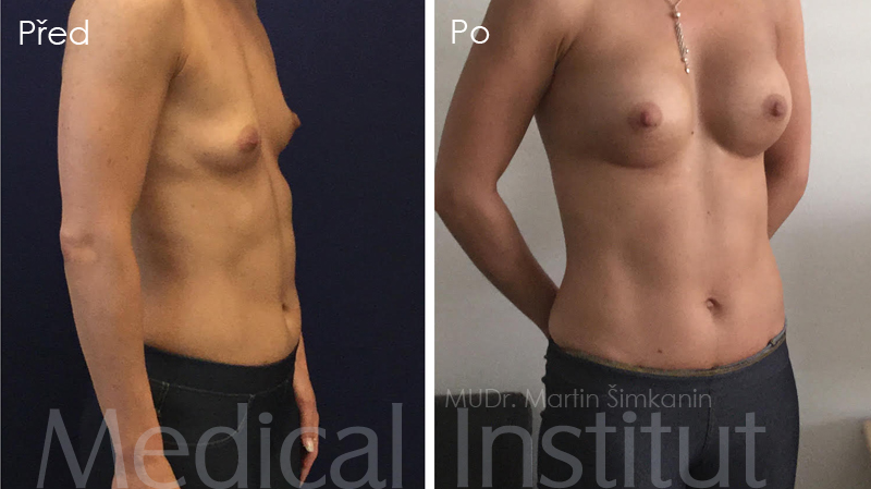 Zvětšení prsou implantáty Motiva - plastická chirurgie Medical Institut